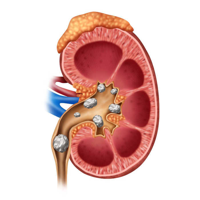 Can a Keto Diet Cause Kidney Stones?